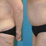 Lower Body Lift #11 - Before and After