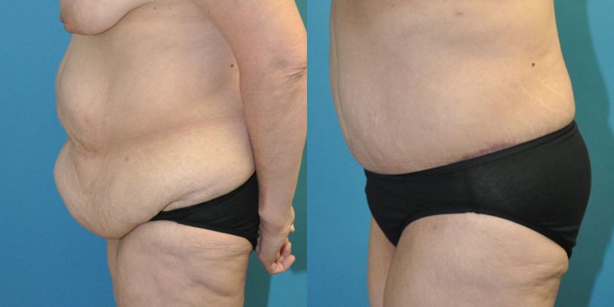 Lower Body Lift #11 - Before and After