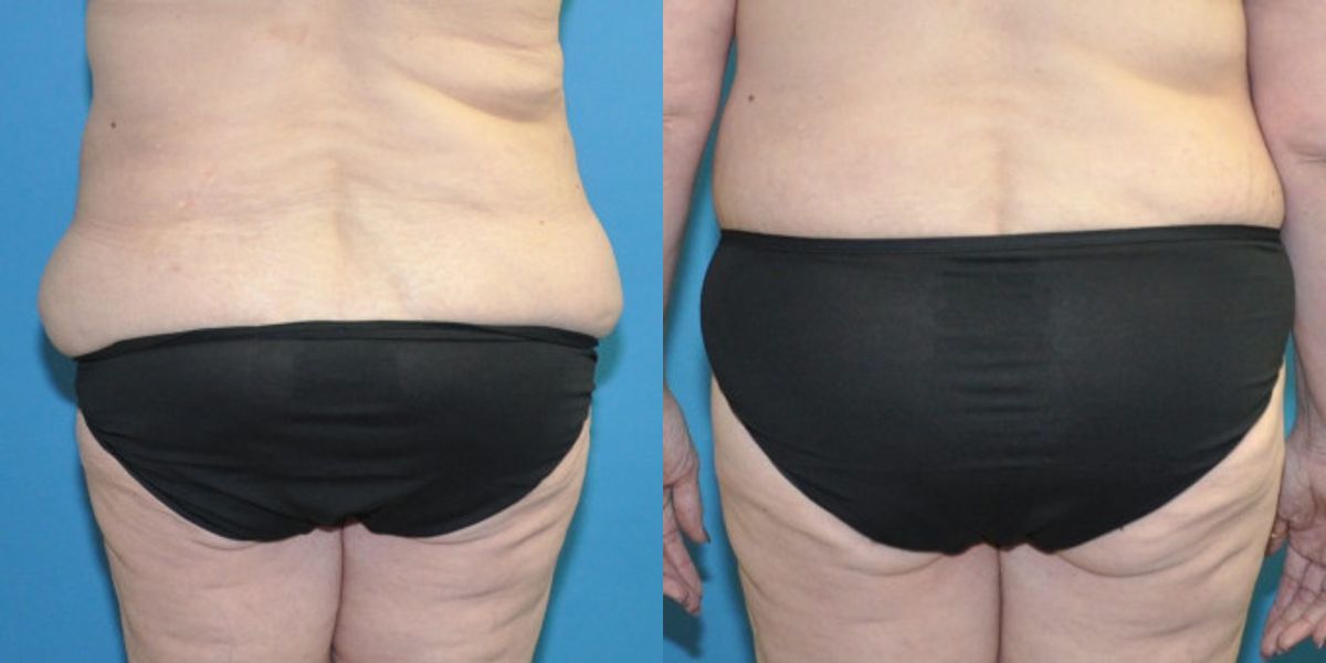 Lower Body Lift #11 - Before and After
