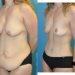 Mommy Makeover #2 - Before and After