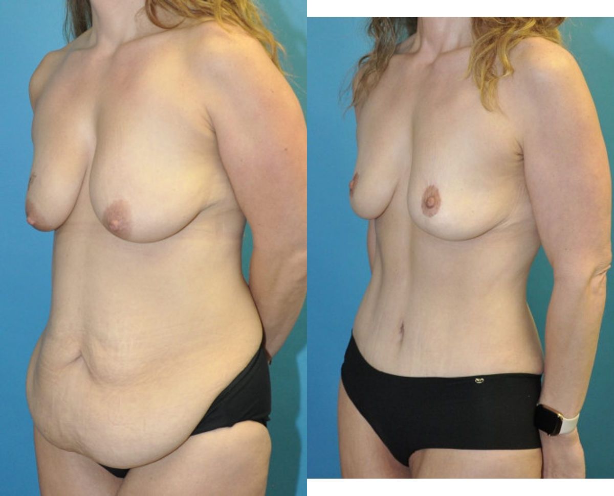 Mommy Makeover #2 - Before and After