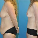 Mommy Makeover #2 - Before and After