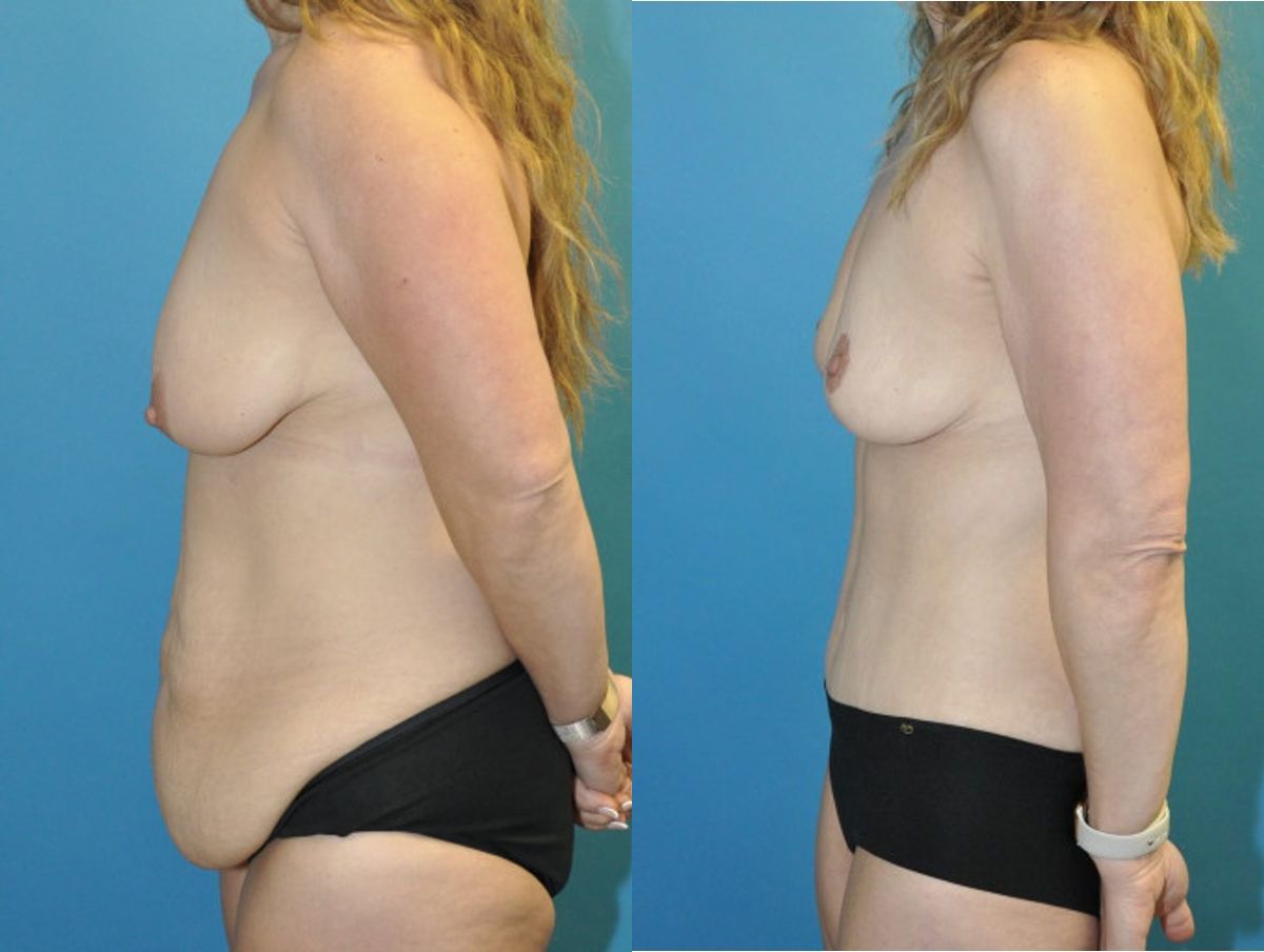 Mommy Makeover #2 - Before and After