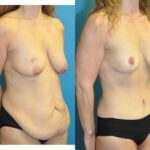 Mommy Makeover #2 - Before and After