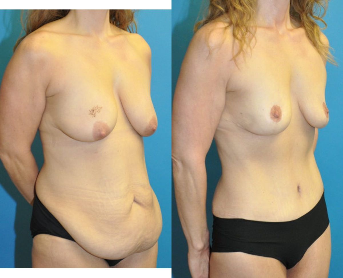 Mommy Makeover #2 - Before and After