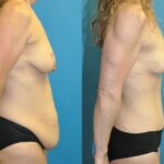 Mommy Makeover #2 - Before and After