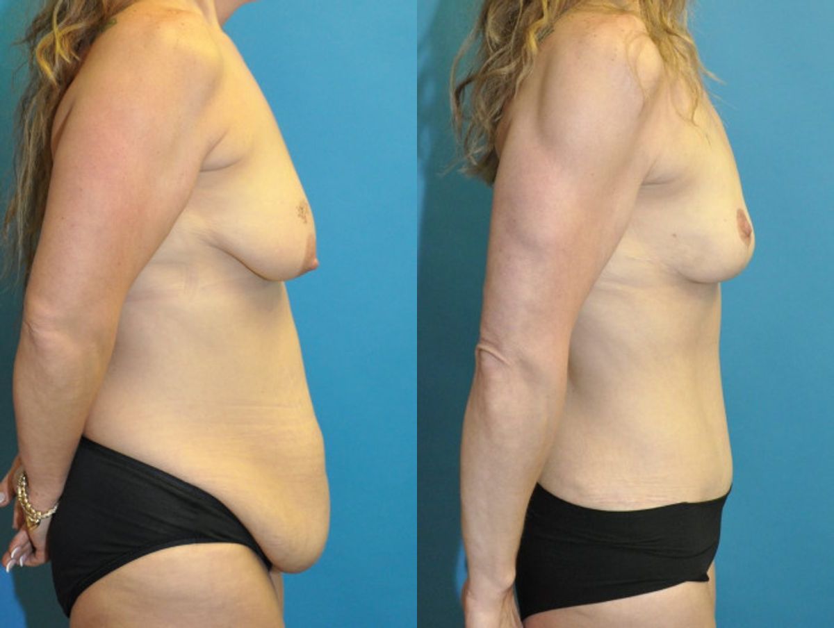 Mommy Makeover #2 - Before and After