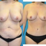 Mommy Makeover #23 - Before and After