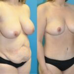 Mommy Makeover #23 - Before and After