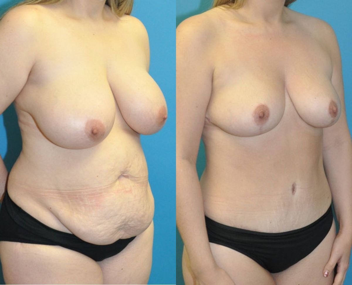 Mommy Makeover #23 - Before and After