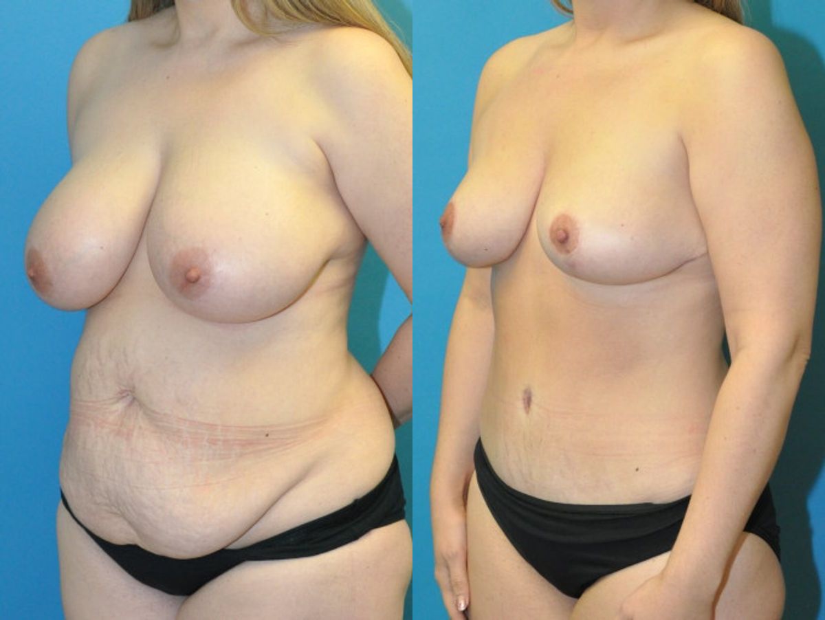 Mommy Makeover #23 - Before and After