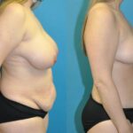 Mommy Makeover #23 - Before and After