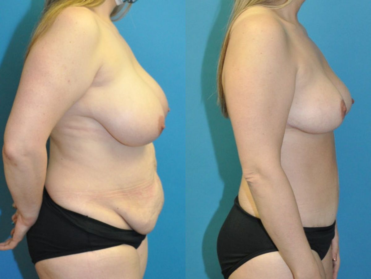 Mommy Makeover #23 - Before and After