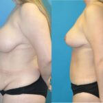 Mommy Makeover #23 - Before and After