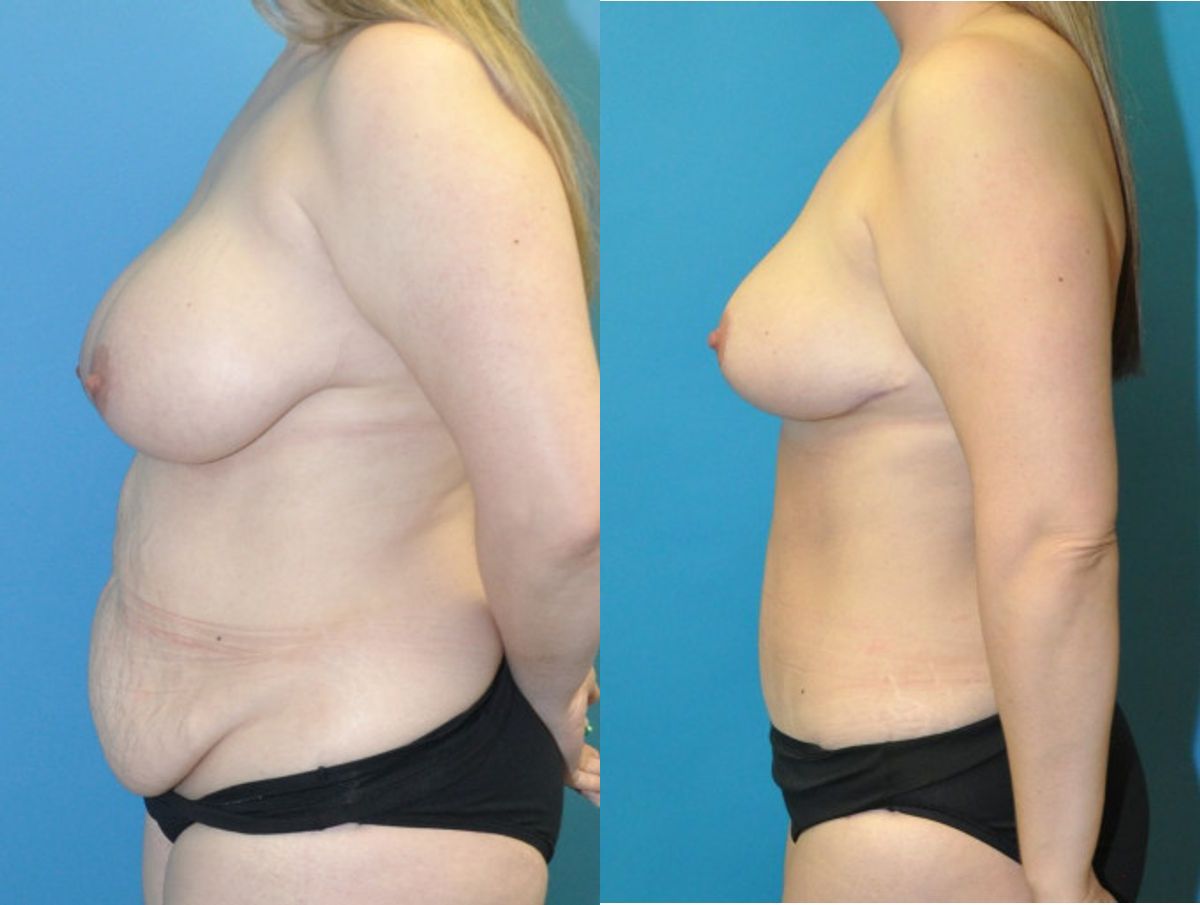 Mommy Makeover #23 - Before and After