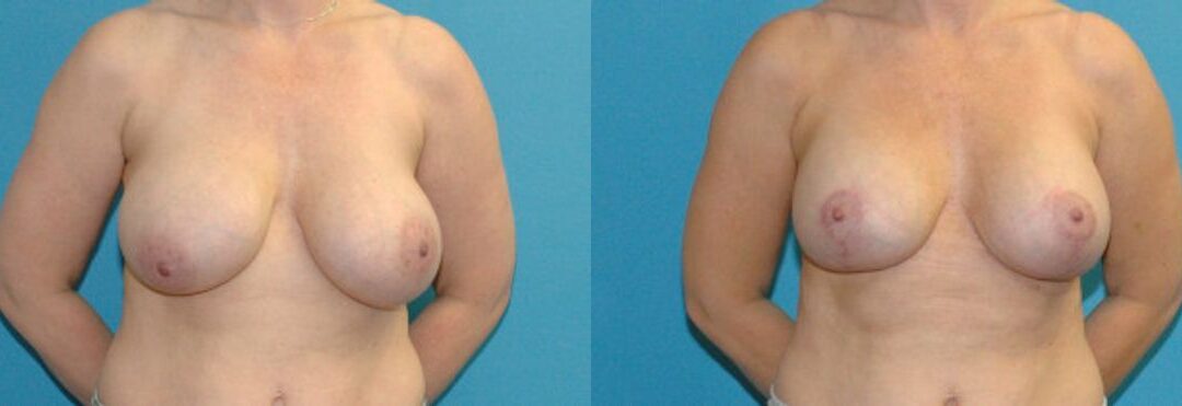 Breast Augmentation And Lift #26