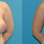 Breast Augmentation And Lift #26 - Before and After