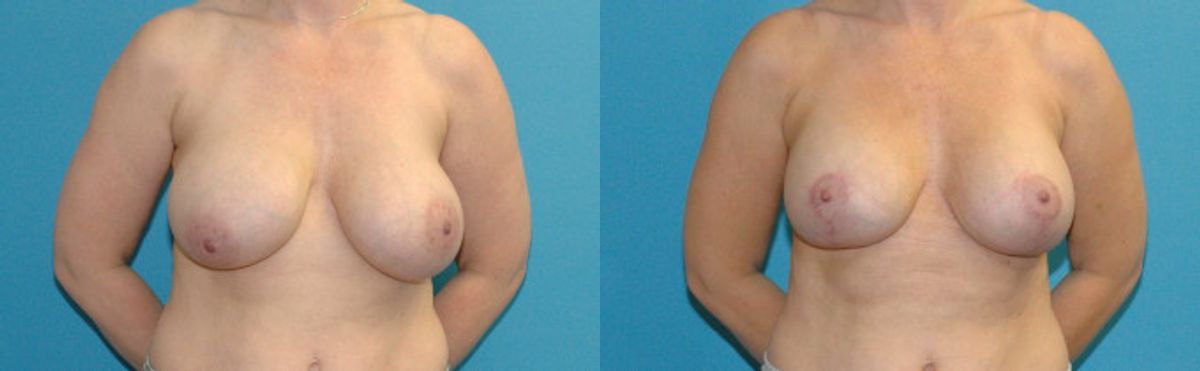 Breast Augmentation And Lift #26 - Before and After