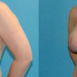 Breast Augmentation And Lift #26 - Before and After