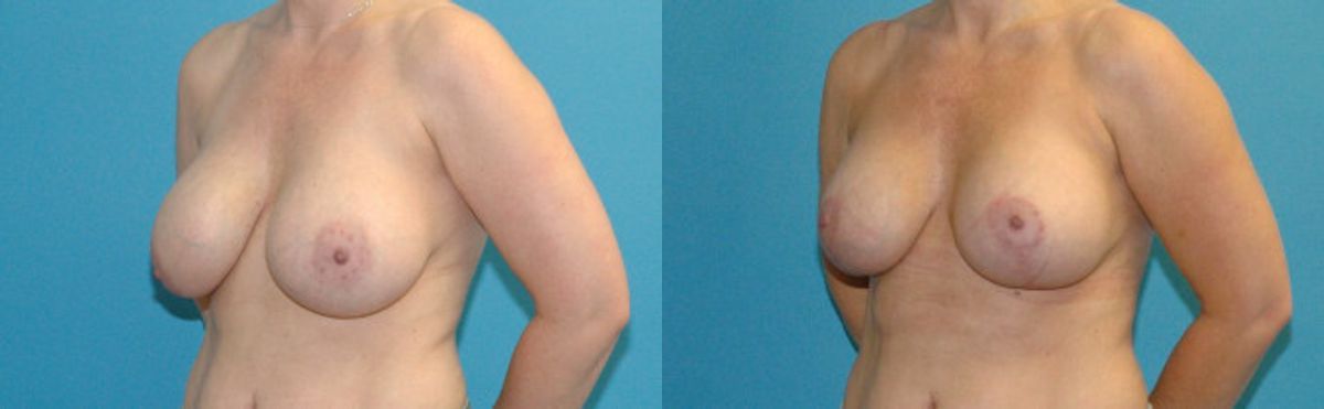 Breast Augmentation And Lift #26 - Before and After