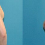 Breast Augmentation And Lift #26 - Before and After