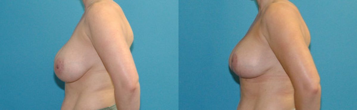 Breast Augmentation And Lift #26 - Before and After