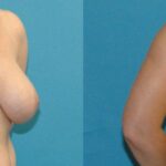 Breast Augmentation And Lift #26 - Before and After
