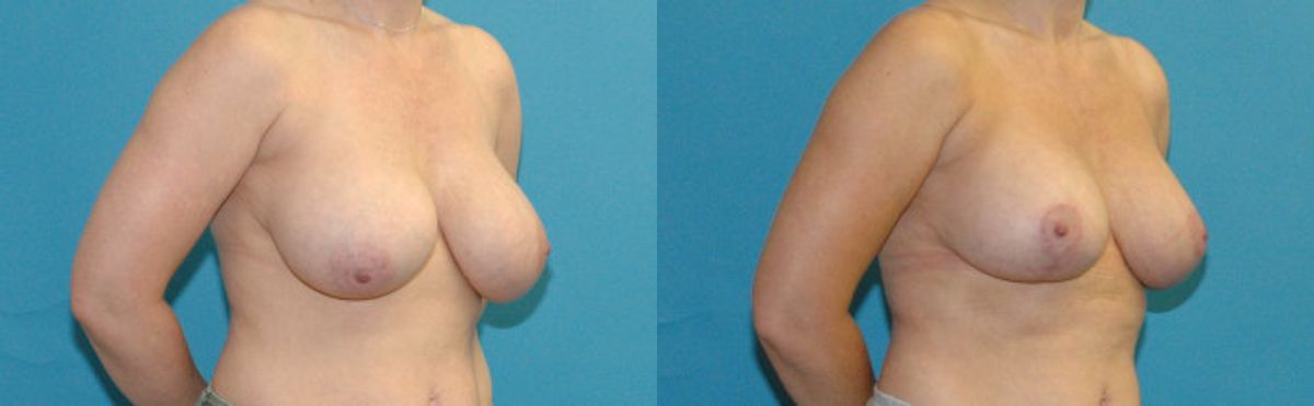 Breast Augmentation And Lift #26 - Before and After