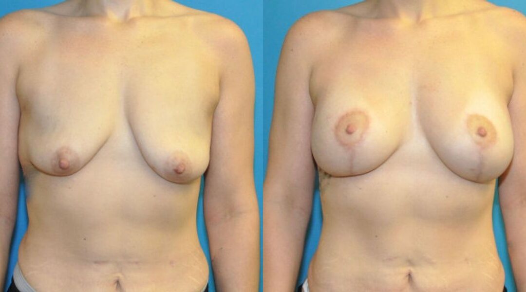 Breast Augmentation And Lift #27