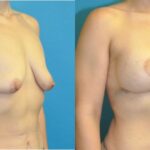 Breast Augmentation And Lift #27 - Before and After