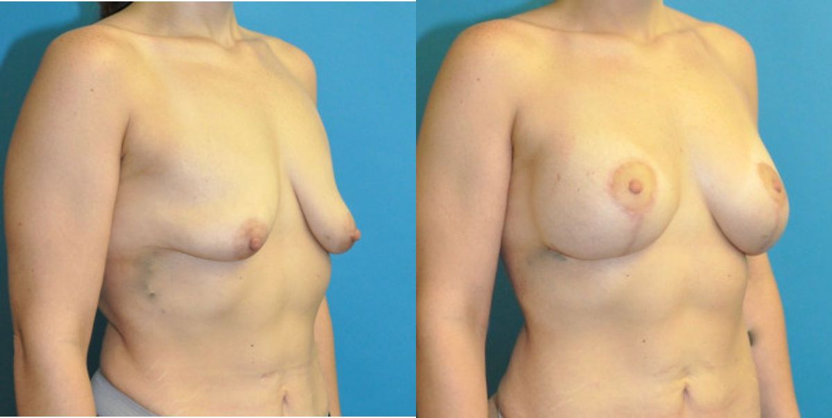 Breast Augmentation And Lift #27 - Before and After