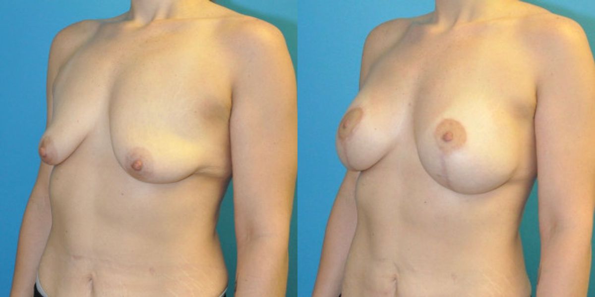 Breast Augmentation And Lift #27 - Before and After
