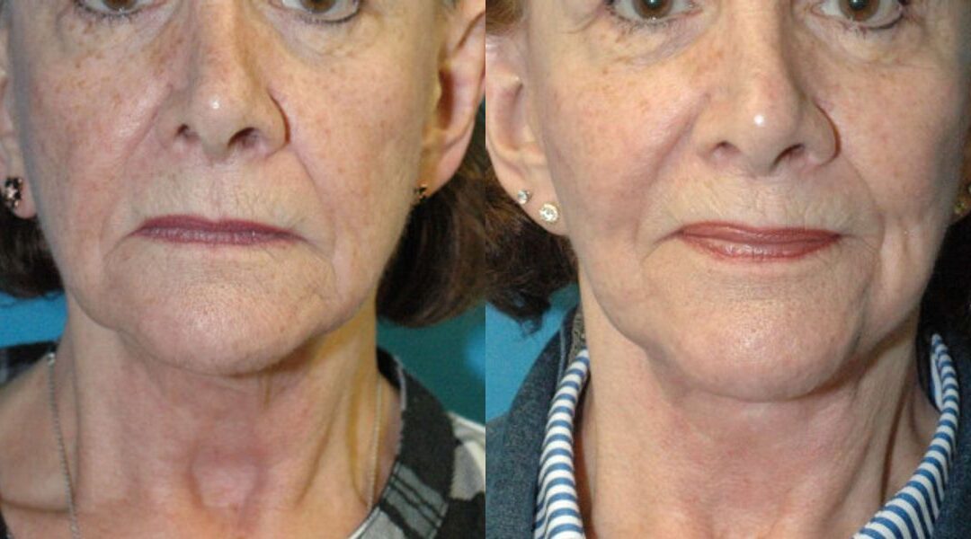 Face And Neck Lift #10