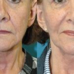 Face And Neck Lift #10 - Before and After