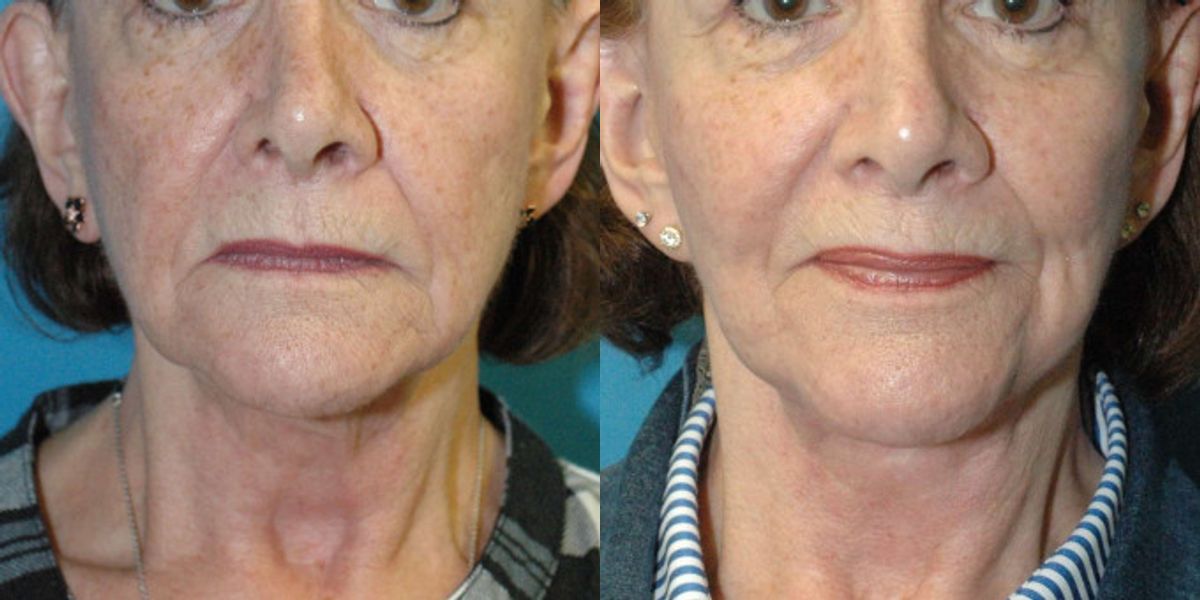 Face And Neck Lift #10 - Before and After