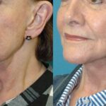 Face And Neck Lift #10 - Before and After