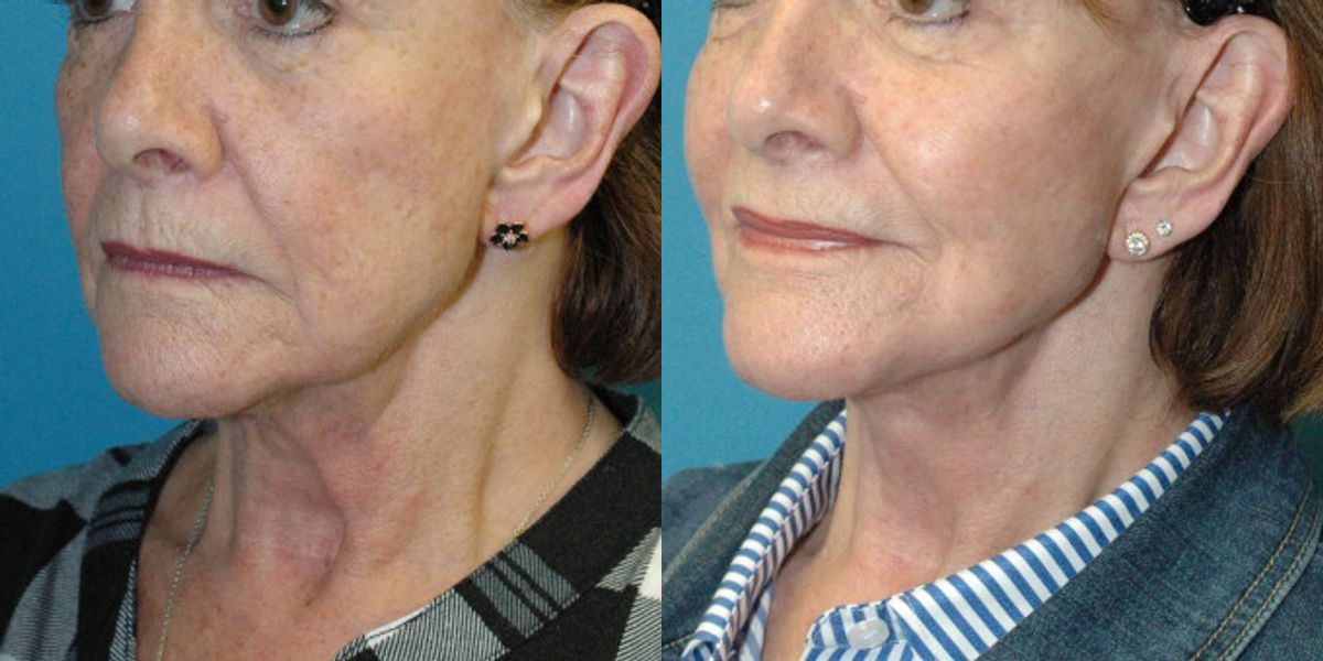Face And Neck Lift #10 - Before and After