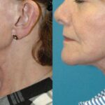 Face And Neck Lift #10 - Before and After
