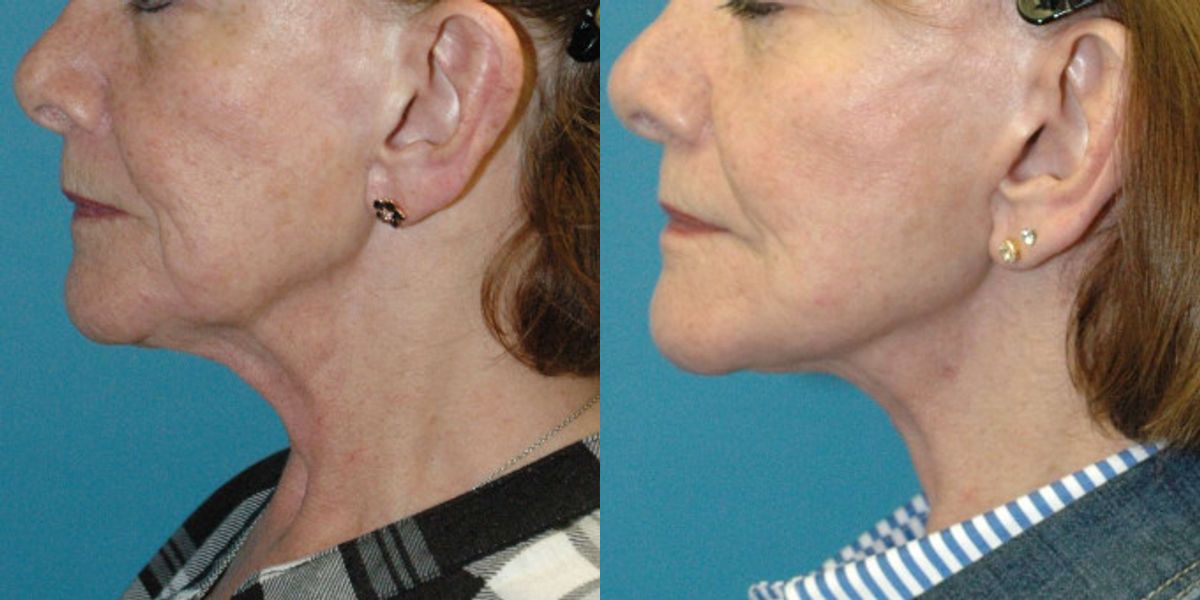 Face And Neck Lift #10 - Before and After