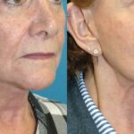 Face And Neck Lift #10 - Before and After
