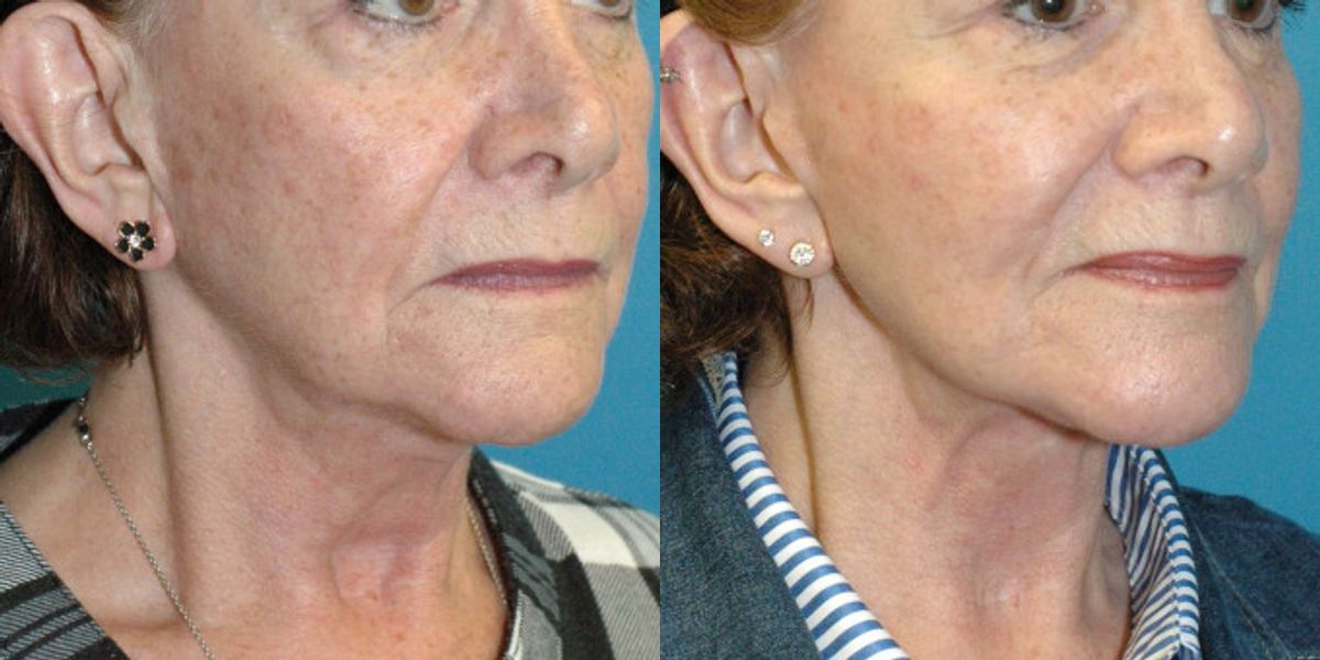 Face And Neck Lift #10 - Before and After