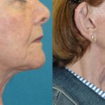 Face And Neck Lift #10 - Before and After