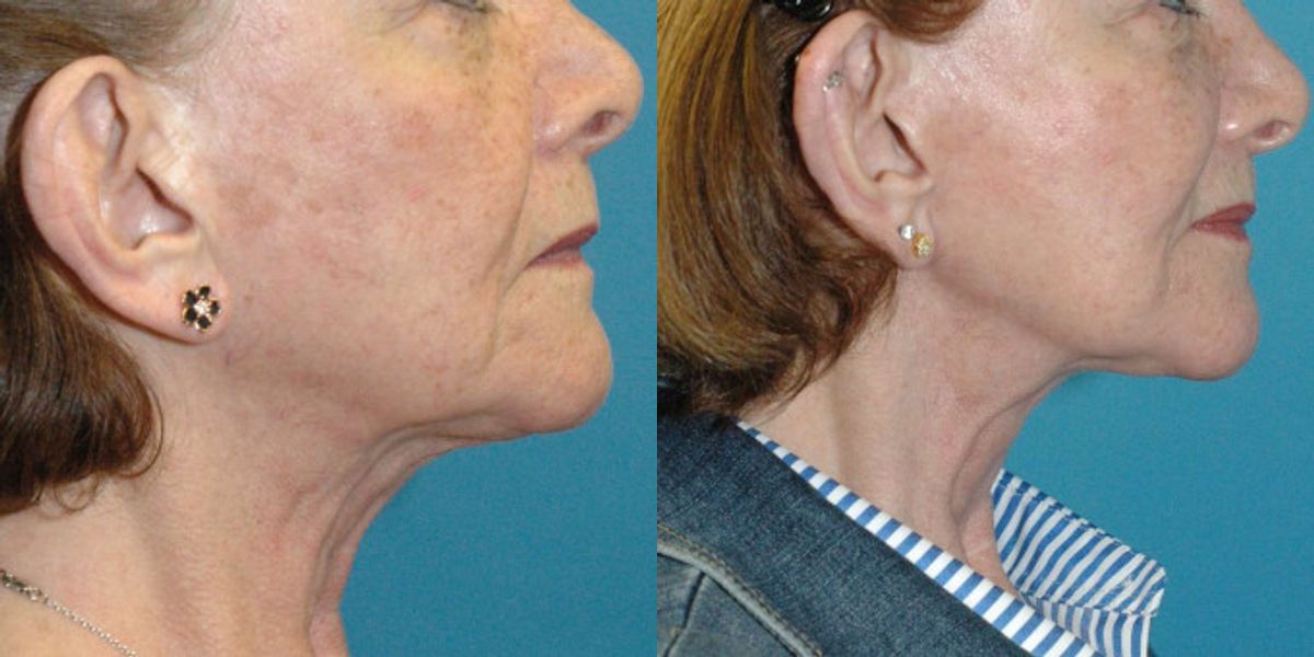 Face And Neck Lift #10 - Before and After