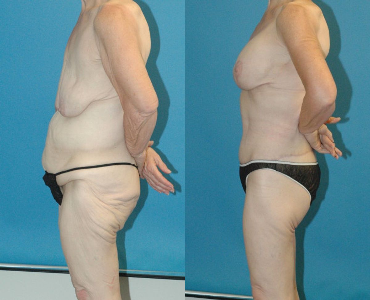 Lower Body Lift Mastopexy Augmentation Armlift And Thighlift - Before and After