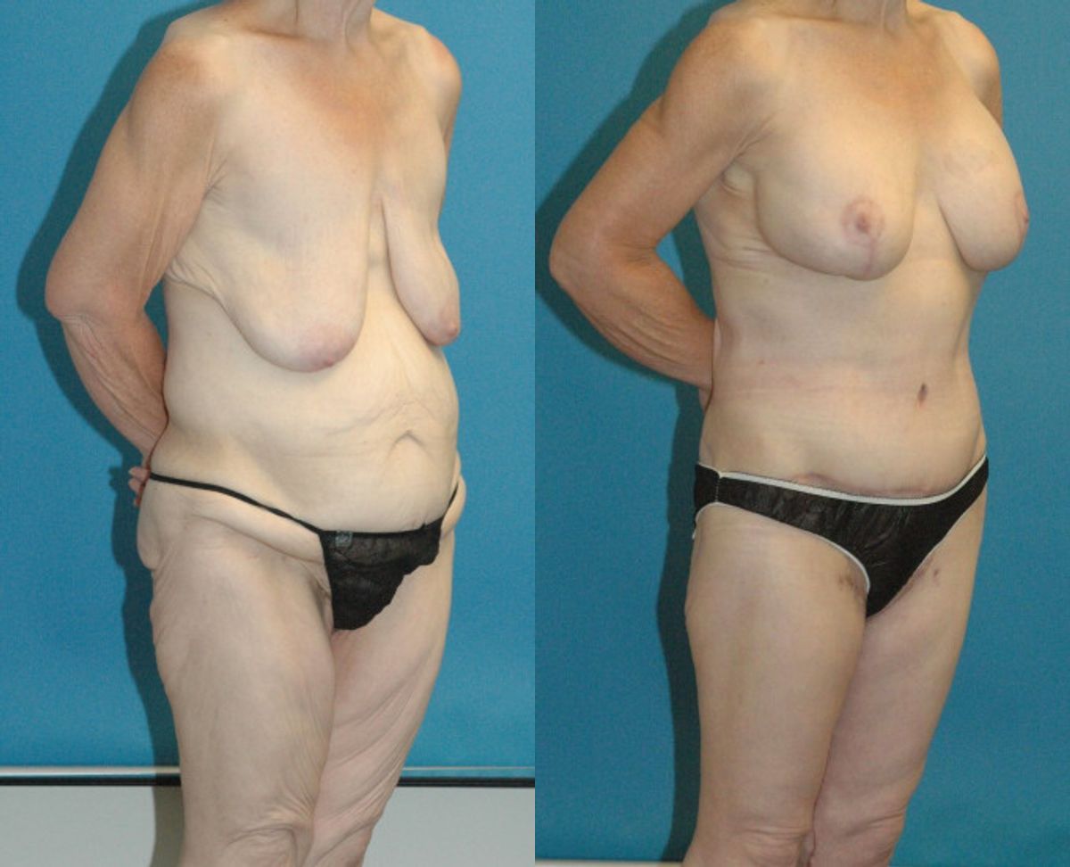 Lower Body Lift Mastopexy Augmentation Armlift And Thighlift - Before and After