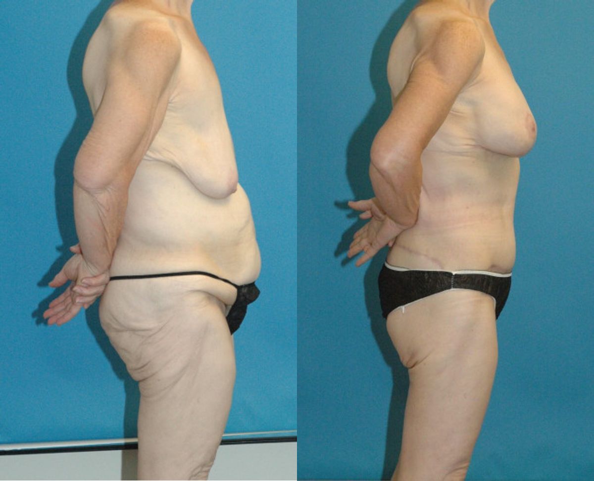 Lower Body Lift Mastopexy Augmentation Armlift And Thighlift - Before and After