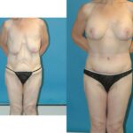 Lower Body Lift Mastopexy Augmentation Armlift And Thighlift - Before and After