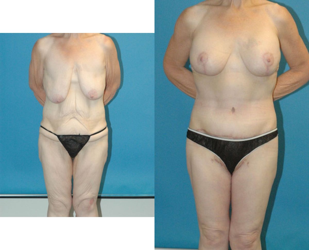 Lower Body Lift Mastopexy Augmentation Armlift And Thighlift - Before and After