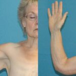 Lower Body Lift Mastopexy Augmentation Armlift And Thighlift - Before and After
