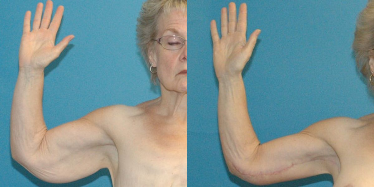 Lower Body Lift Mastopexy Augmentation Armlift And Thighlift - Before and After